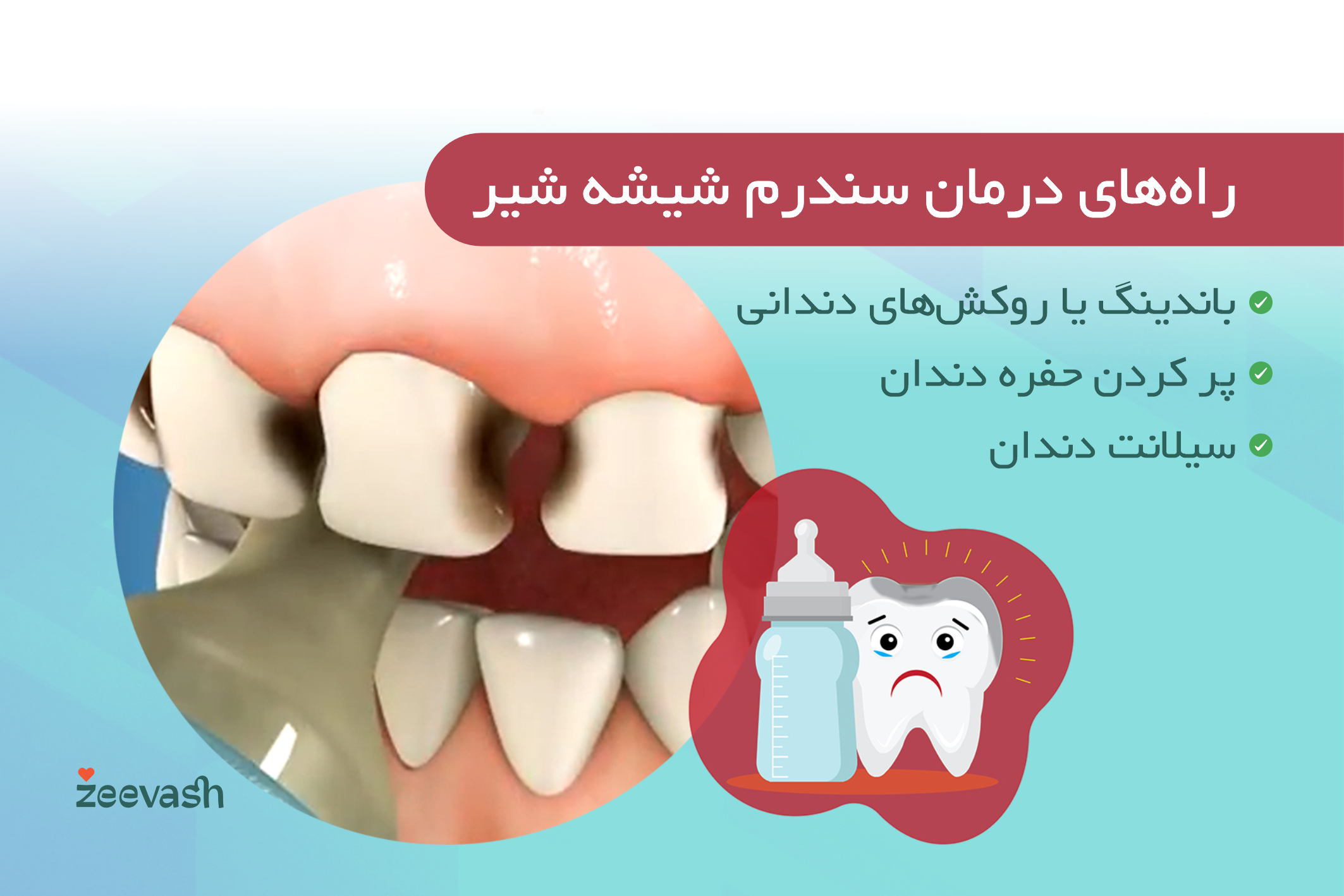 راه های درمان سندروم شیشه شیر